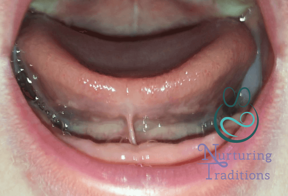 Tongue and Lip Ties